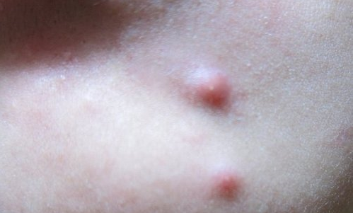 Should You Pop Pimples