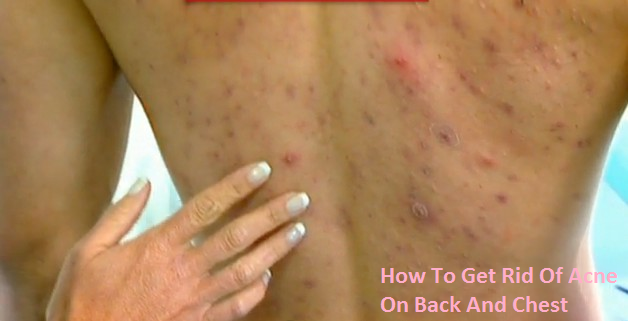 How to get rid of acne on chest