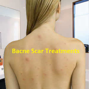 How To Get Rid Of Bacne Scars (back Acne)