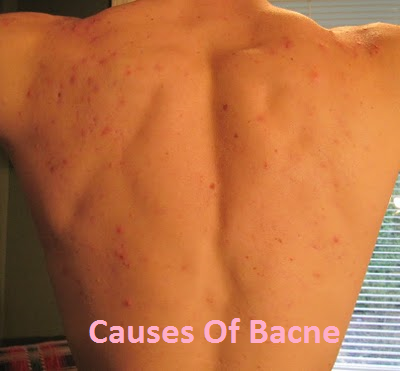 What Causes Bacne 