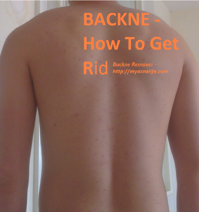 BACKNE remover- how to get rid of backne